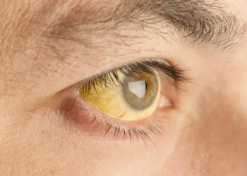 Febre Amarela Sintomas