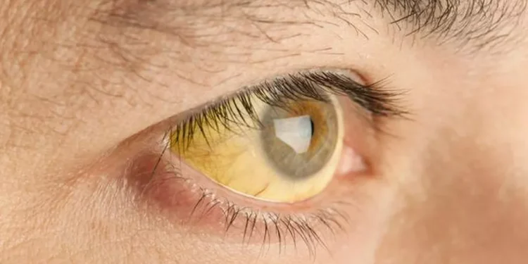 Febre Amarela Sintomas