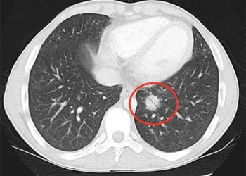 cancer-de-pulmao-exame-de-tomografia-tesla-imagem