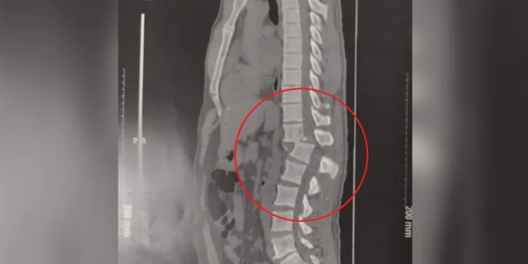 Exame mostra gravidade da lesão em coluna de homem atingido por aparelho em academia no Ceará