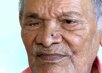 Foto idoso com um dos lados do olho fechado após cirurgia