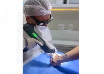 Laser de picossegundos revoluciona o tratamento de manchas da pele em Manaus