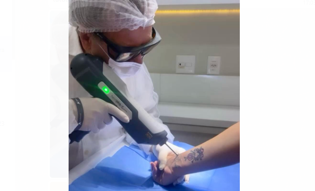 Laser de picossegundos revoluciona o tratamento de manchas da pele em Manaus