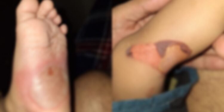 Os pés e pernas do bebê com queimaduras graves - (Foto: Reprodução)