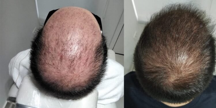 Desvendando os mitos do transplante