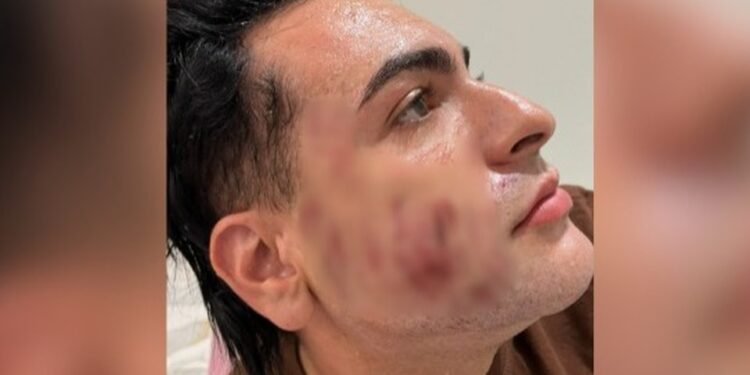 vítima de peeling de Fenol