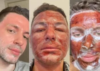 Uso de fenol - (Foto: Reprodução/Tik Tok)