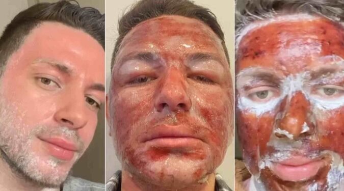 Uso de fenol - (Foto: Reprodução/Tik Tok)