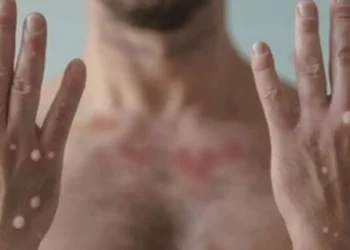 Saúde negocia compra de 25 mil doses de vacina contra mpox