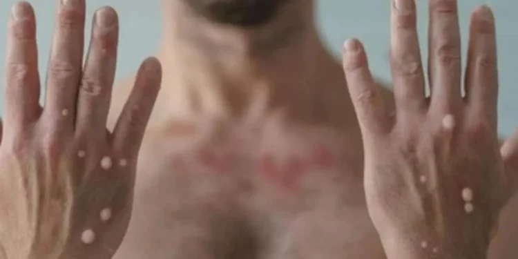 Saúde negocia compra de 25 mil doses de vacina contra mpox