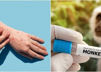 Amazonas registra 11 casos confirmados de Mpox