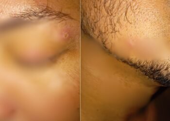 Universitário com Mpox