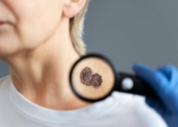 cancer-pele-amazonas