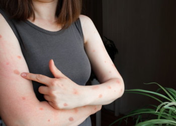 Amazonas registra 44 casos de Mpox aponta relatório da FVS