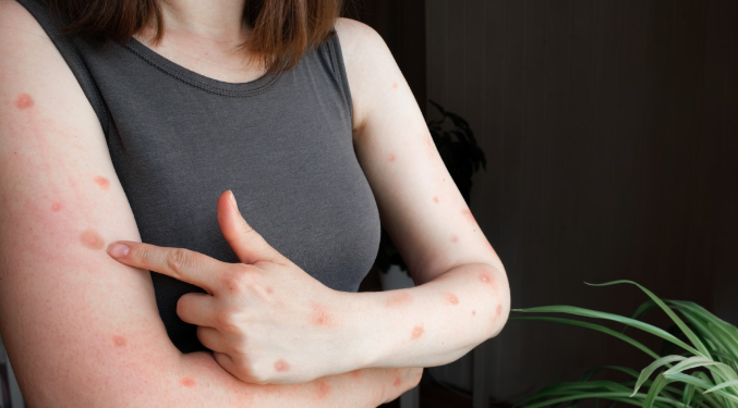 Amazonas registra 44 casos de Mpox aponta relatório da FVS