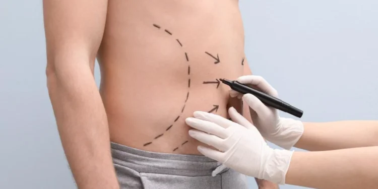 Médicos alertam sobre riscos de lipoaspiração fora de hospital