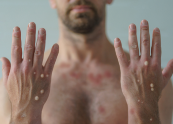 Amazonas registra 74 casos confirmados de Mpox