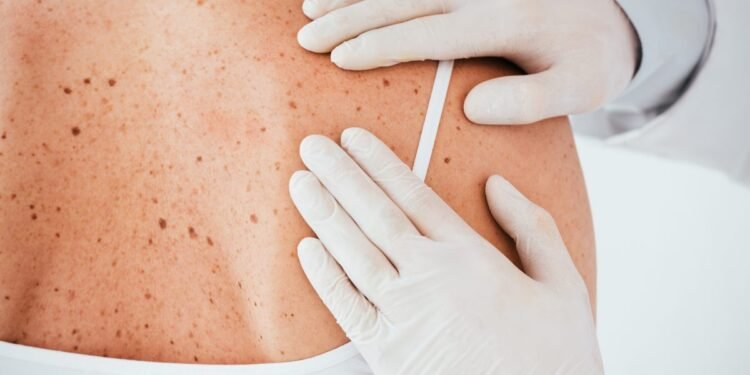 Ação gratuita para prevenção e diagnóstico do câncer de pele será realizada em Manaus