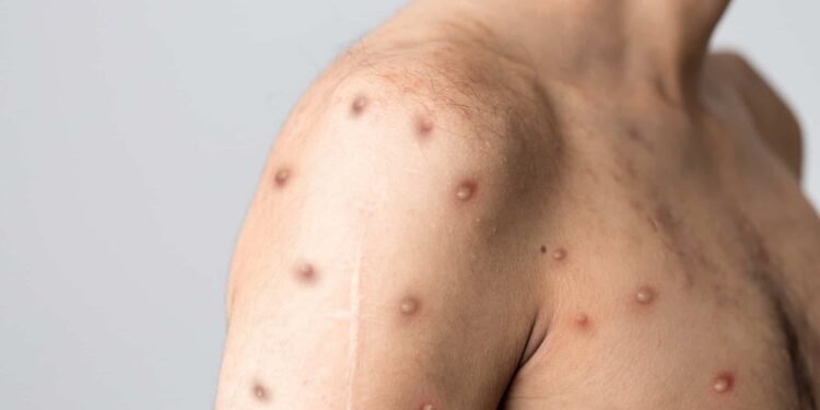 Amazonas registra 63 casos confirmados de Mpox, aponta FVS- (Foto: Berkay Ataseven /iStock)