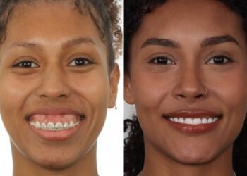 Entenda o procedimento de reconstrução facial feito por Giovanna, irmã de Gracyanne Barbosa do BBB 25