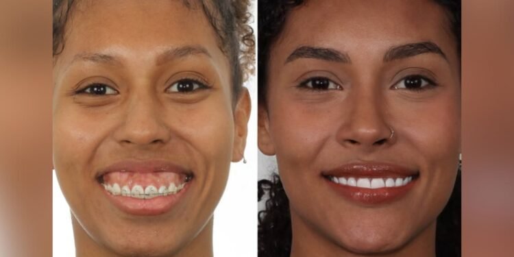 Entenda o procedimento de reconstrução facial feito por Giovanna, irmã de Gracyanne Barbosa do BBB 25