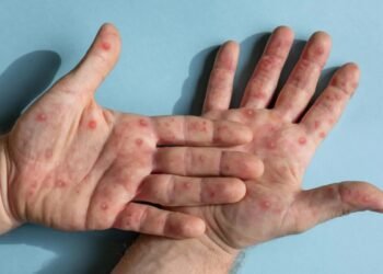 Mpox ainda é emergência de saúde, diz OMS