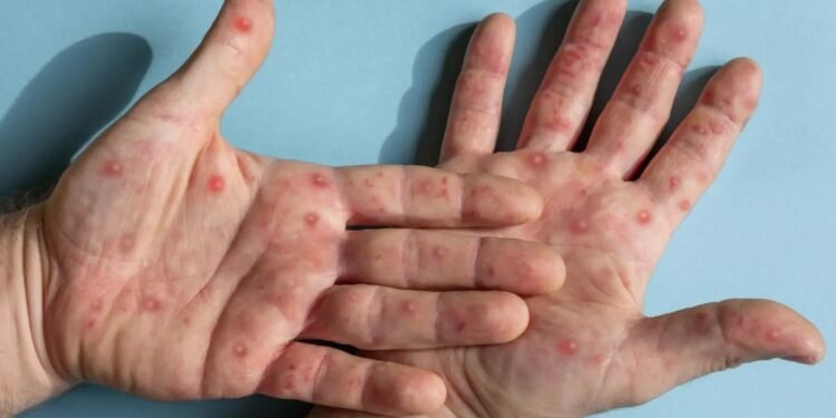 Mpox ainda é emergência de saúde, diz OMS