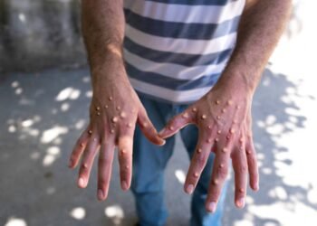 Amazonas tem 17 casos confirmados de Mpox; 100% em homens