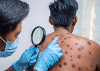 Cresce os casos confirmados de mpox em Manaus; todos em homens