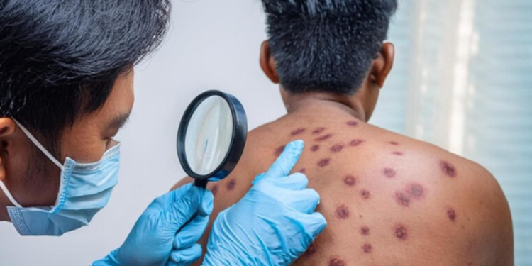 Cresce os casos confirmados de mpox em Manaus; todos em homens
