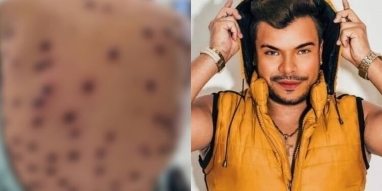 Casos de mpox crescem no Amazonas e cantor morre da doença no Pará