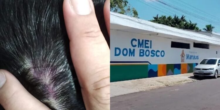 Criança autista sai da escola municipal com hematoma na cabeça e caso vai parar na DEPCA