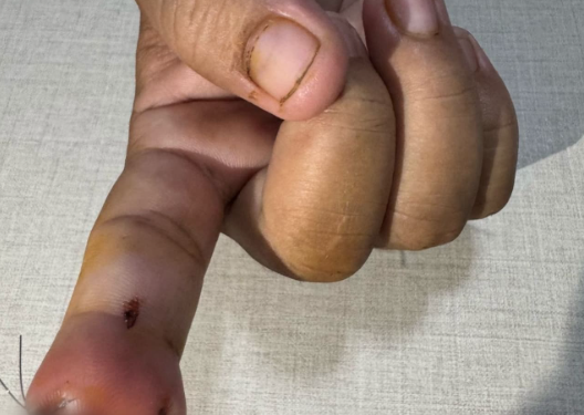 Durante discussão, namorado morde e arranca dedo da companheira em Manaus