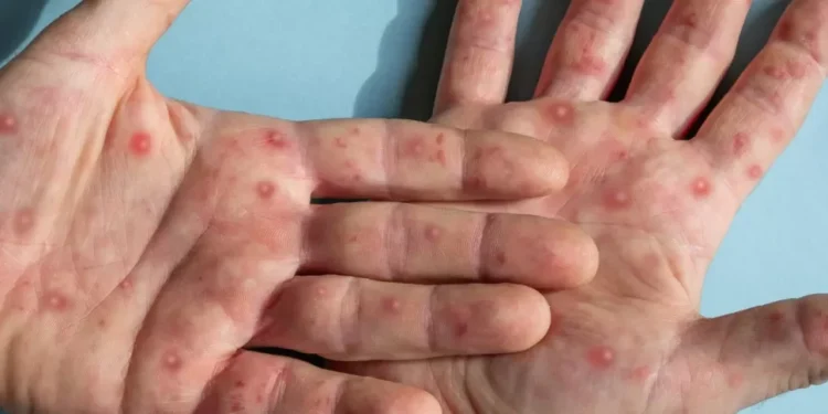 Manaus contabiliza 30 casos confirmados de Mpox; todos em pacientes homens