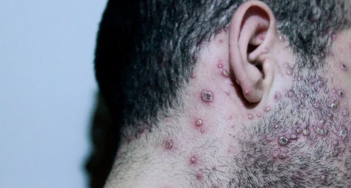 Sobe para 22 o número de homens com mpox em Manaus