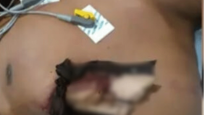 Jovem tem tórax perfurado por pedaço de madeira em Barcelos no Amazonas