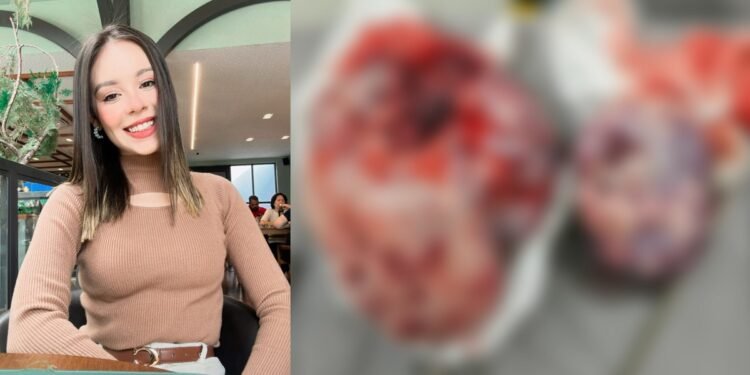 Jovem descobre câncer avançado após cirurgia de emergência e luta por tratamento urgente