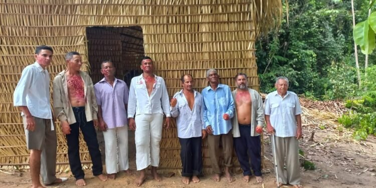 documentario-hanseniase-manaus