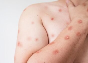 Primeiro caso de Mpox em 2026 é confirmado em Porto Alegre