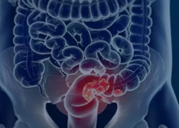 Rastreamento para câncer colorretal pode ser implementado no SUS