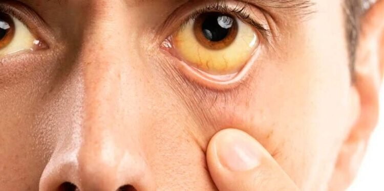 Amazonas registra queda de 69% nos casos de hepatites virais