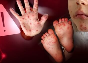 Casos de doença mão-pé-boca avançam no Amazonas e acendem alerta para prevenção