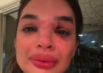 ‘Meu rosto todo deformado’: dentista denuncia agressão do marido com taco de beisebol